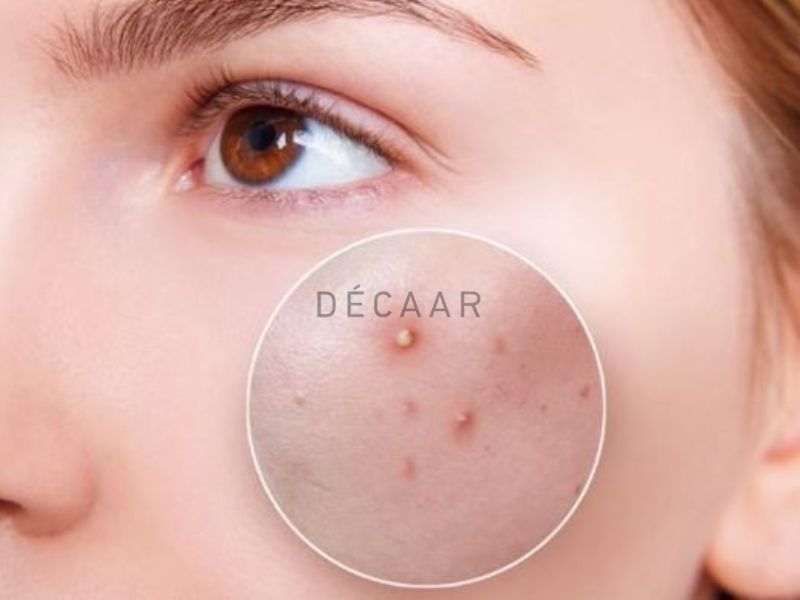 Peel da bị đẩy mụn